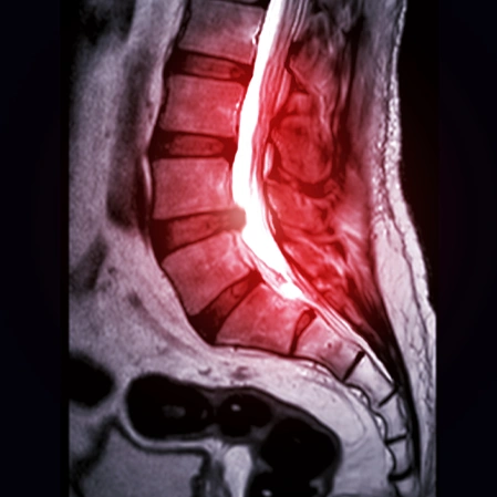 Thermography image of the lower back